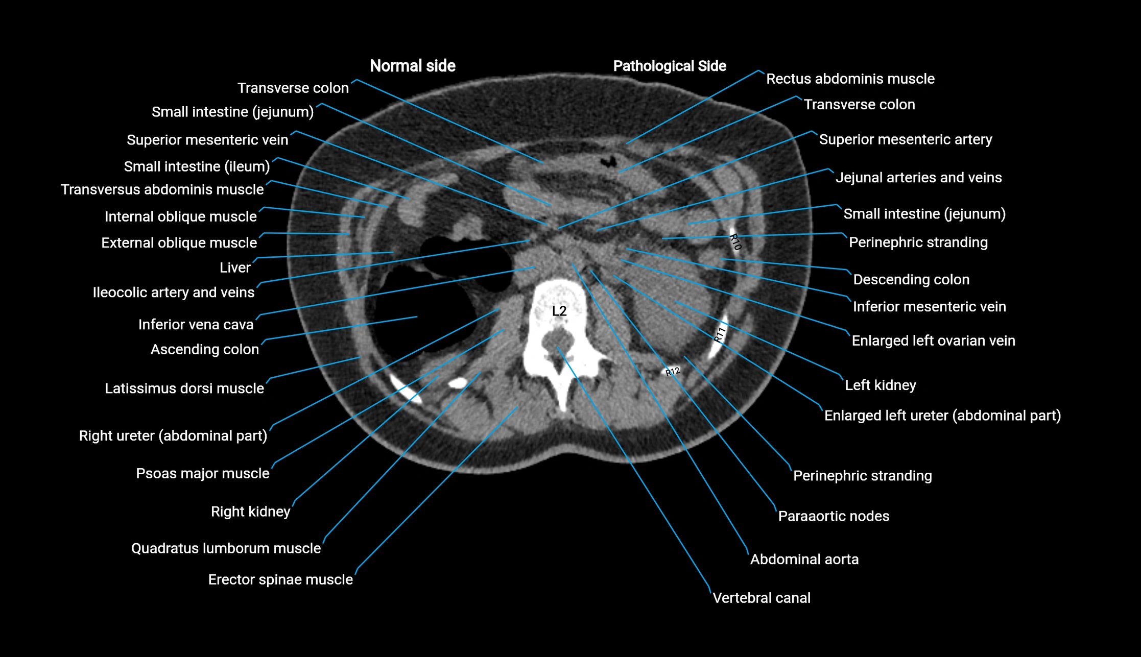 CT KUB axial cross sectional anatomy  radiology image -img-00201-00056.webp
